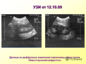 Нефроптоз по узи