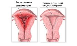 Гипоплазия эндометрия и беременность