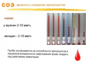 Очень высокая СОЭ и субфебрилитет