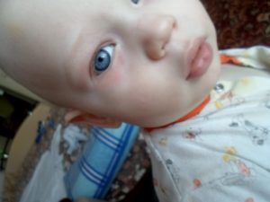 Опух левый глаз у ребенка