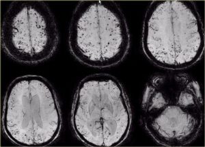 Очаги микроангиопатии в лобных долях мозга