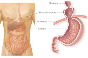 Грыжа пищевода и полип желудка