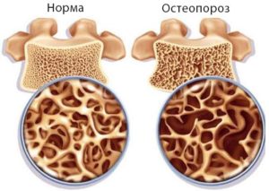 Остеопороз и беременность