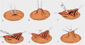 Операция по коррекции втянутых сосков