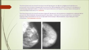 Фиброзно кистозная мастопатия инволютивных молочных желез
