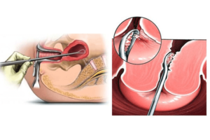 Гиперплазия эндометрия, вакуумная чистка