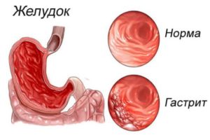 Неприятный привкус при гастрите и реакция на лекарства