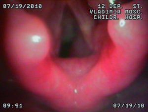 Гиперплазия гортани