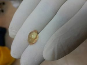 Не вышло околоплодное яйцо при медикаментозном аборте