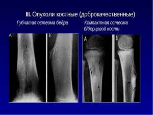 Остеома берцовой кости