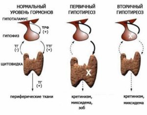 Гипоплазия щитовидной железы но гормоны в норме