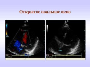 Открытое овальное окно при беременности