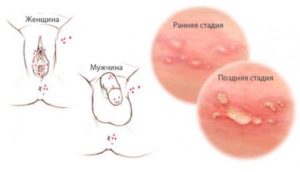 Генитальный герпес, частые рецидивы