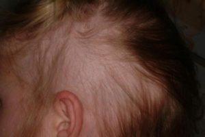 Не растут волосы после аллергии на голове у ребенка