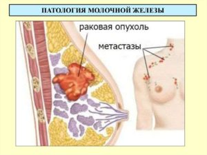 Фиброаденома при грудном вскармливании
