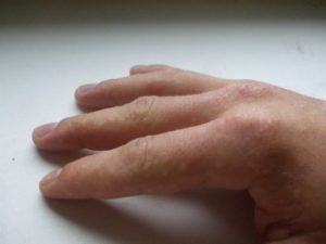 Недолеченный грибок на пальцах рук в виде водянистых пузырьков