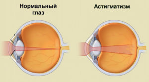 Нужно ли при диагнозе астигматизм закрывать один глаз