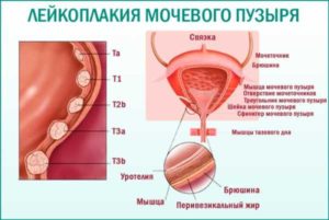 Ноет низ живота, ощущение неполного испражнения мочевого пузыря