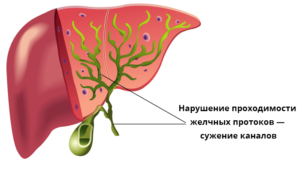 Холангит у ребенка