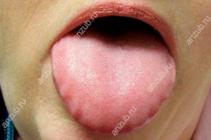 Опух язык и горло