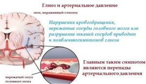 Очаги микроангиопатии в лобных долях мозга