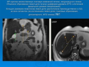 Объемное образование левой доли печени