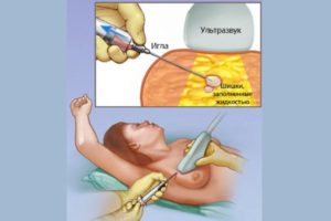 Фиброаденомы молочных желез, операция