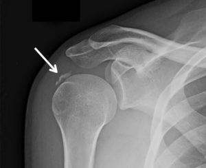 Перелом левой плечевой кости в н/3 со смещением