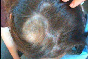 Не растут волосы после аллергии на голове у ребенка