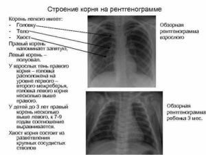 Образование в головке корня левого лёгкого