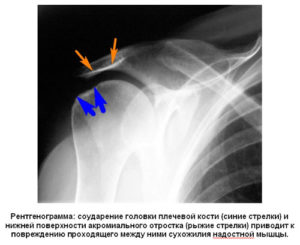 Неизвестное образование в плече