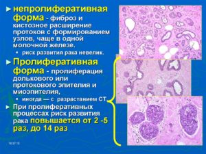 Непролиферативный фиброаденоматоз дольковой формы