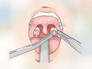 Гнойный запах из носа (рта) после аденотомии и частичной тонзилоктомии