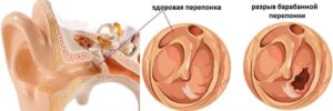 Острый посттравматический средний отит