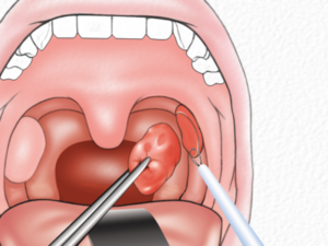 Одностороннее увеличение миндалины
