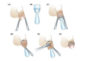 Фимоз, обрезание