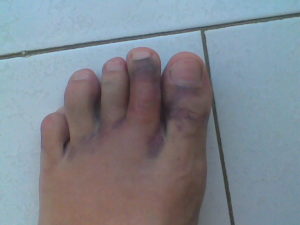 Перелом 3 пальца на ноге и осколок 4 пальца левой ноги