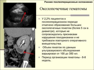 Гематома с уплотнением после операции