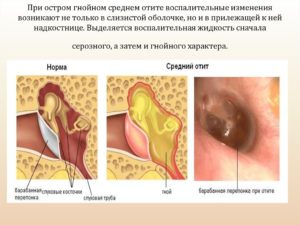 Острый гнойный средний отит