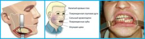 Немеет часть лица после удаления зуба мудрости