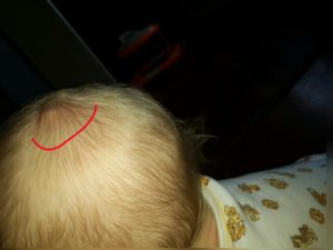 Небольшая шишечка на голове у ребенка