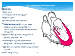 Недостаточность аортального клапана - насколько это страшно?