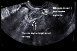 Новообразование между маткой и мочевым пузырём. Каковы лечения?