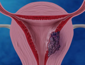 Опухоль половых губ, отсутствие менструации