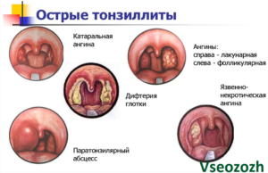 Острый тонзиллит