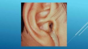 Гноетечение из уха