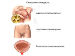 Хламидиоз у мужа, у меня нет