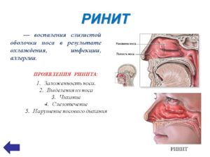 Ощущения распирания в переносице, вазомоторный ринит