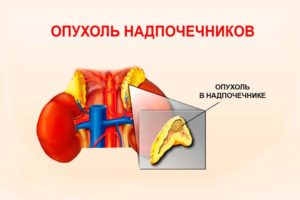 Опухоль надпочечника