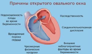 Открытое овальное окно при беременности